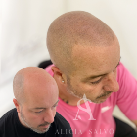 Micropigmentación Capilar 2 (1)