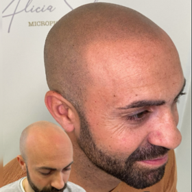 Micropigmentación Capilar 3