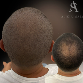 Micropigmentación Capilar 4